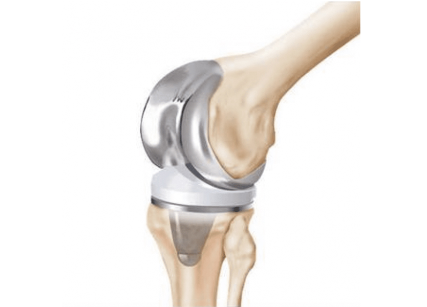 Dr Preetesh Choudhary – Specialist in Joint Reconstruction